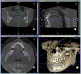 歯科用CTレントゲン画像