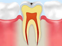 初期の虫歯（C0）