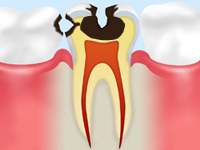 象牙質の虫歯（C2）
