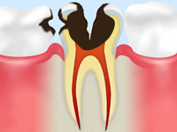 神経の虫歯（C3）