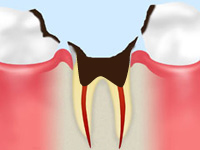 歯根の虫歯（C4）
