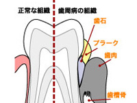 こんな症状は歯周病かもしれません