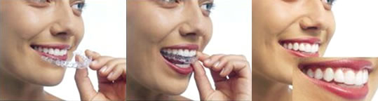 クリアアライナー