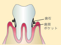 歯周病にご注意を！